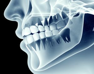 Why do doctors used cone-beamed CT for dental implants in Houston?