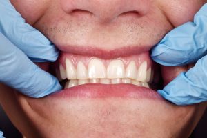 3D printing and dental implants in houston