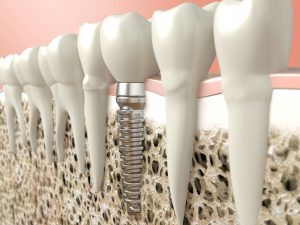 dental implant illustration