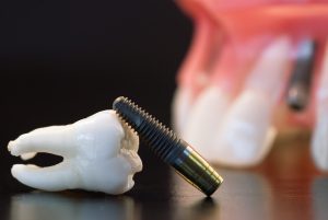 image of implant with crown