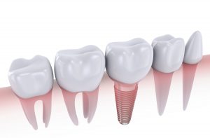 dental implant illustration