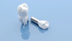 single dental implant blue background