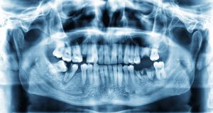 dental x-ray with missing teeth