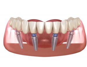 dental implants in Houston supporting full arch of prosthetic teeth