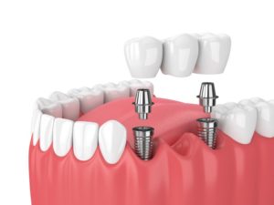 Illustration of two Houston dental implants supporting bridge