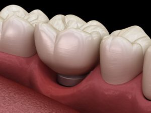 Illustration of peri-implantitis, emergency with dental implant in Houston