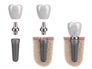 Illustration of three titanium dental implants and their restorations