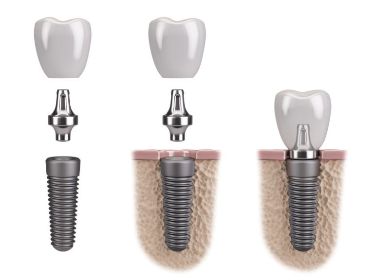 Top 5 Benefits of Titanium Dental Implants