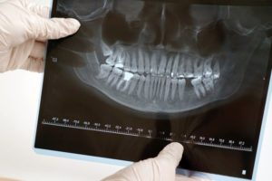 Hands holding dental X-Ray with missing back tooth