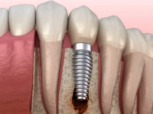 Illustration of peri-implantitis, a cause of dental implant failure