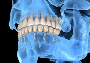 Illustrated representation of patient’s jaw after computer-guided implant placement