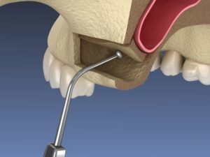 Illustration of dental instrument being used during sinus lift surgery