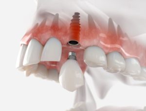 Illustration of titanium dental implant in upper arch