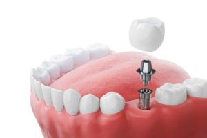 Illustration of dental implant between natural teeth