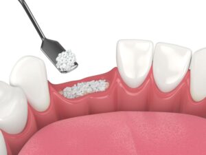 Illustration of bone graft at site of missing tooth