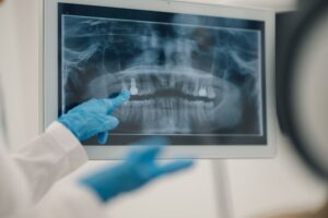 X-ray with gloved hand pointing at dental implant